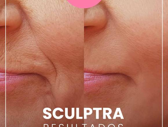 Fillers - Sculptra APARIENCIA MÁS JUVENIL