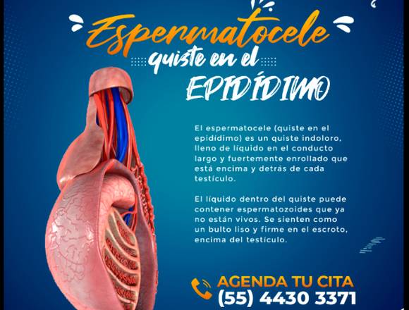 Espermatocele................