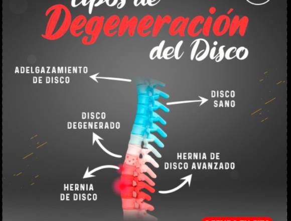 Tipos de Degeneración del Disco