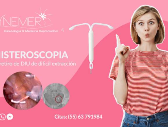 👩⚕️ Retiro de DIU por histeroscopia 👩⚕️