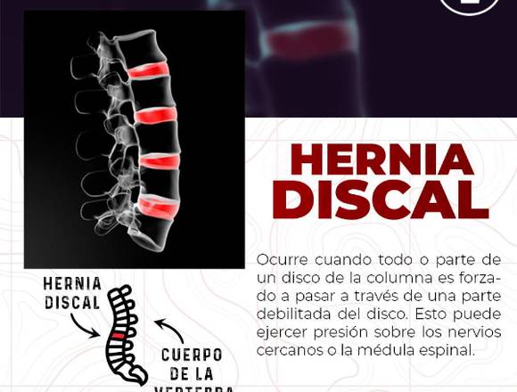 🤒 Hernia Discal 🙆‍♂️