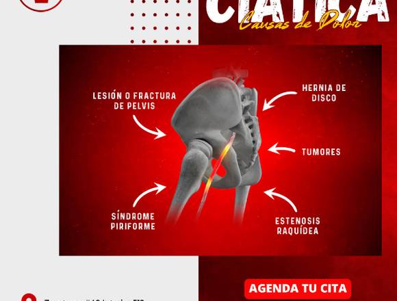 🦵 Ciática: Causas de Dolor 🥵