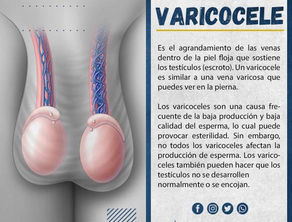 😬 Varicocele 🍆...........