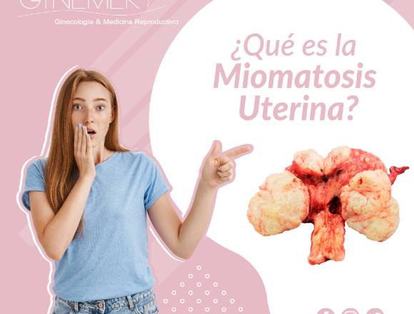 Miomatosis Uterina o Tumores Benignos