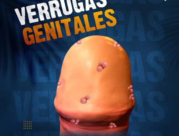 Verrugas Genitales --