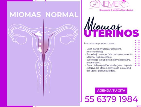 Miomas Uterinos------