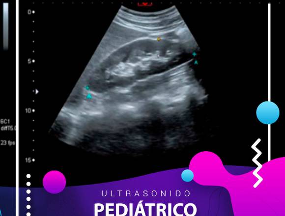 🖥 Ultrasonido Pediátrico de Cadera 👶