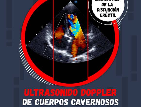 Ultrasonido Doppler de Cuerpos Cavernosos 