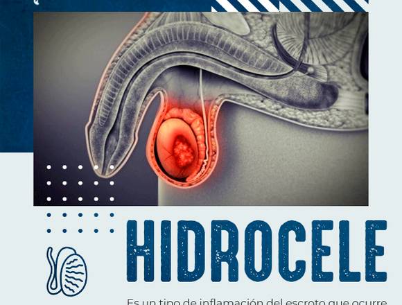 😮 Hidrocele 🥚---------