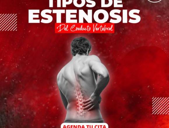 Tipos de Estenosis del Conducto Vertebral