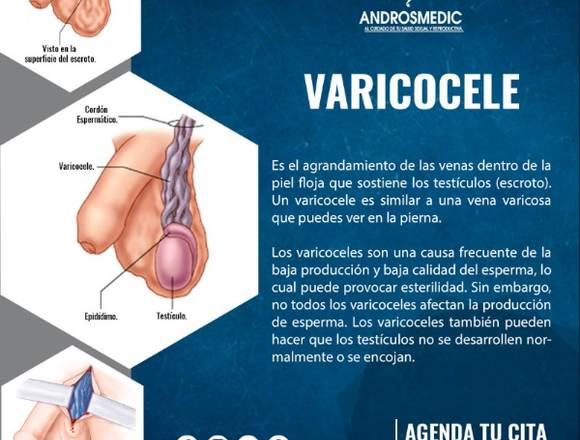 ¿Qué es el Varicocele?