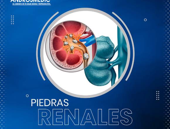 ¿Piedras Renales?...