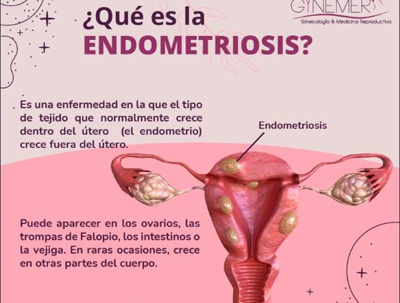 ¿Qué es la endometriosis?