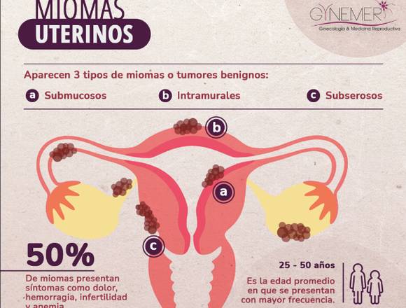 Qué son los MIOMAS UTERINOS 