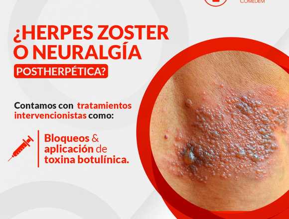 Trata el herpes zoster o neuralgia