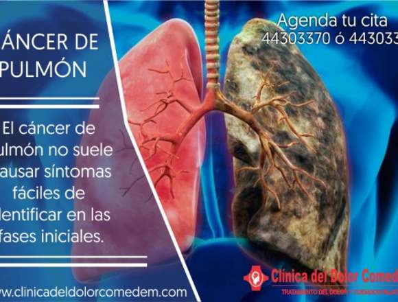 Clínica del dolor Cáncer de pulmón 