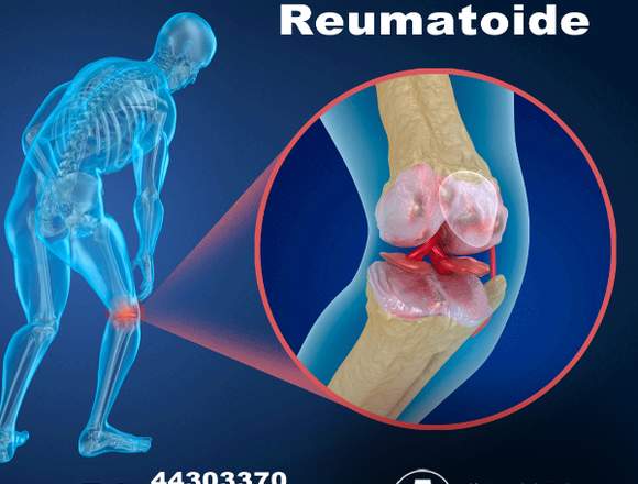 Clínica del Dolor  Artritis Reumatoide 