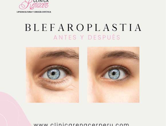 Cirugía de Blefaroplastia