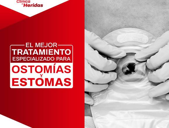 Tratamiento para ostomías y estomas