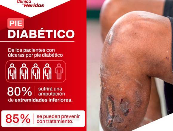 Tratamiento para el pie diabético