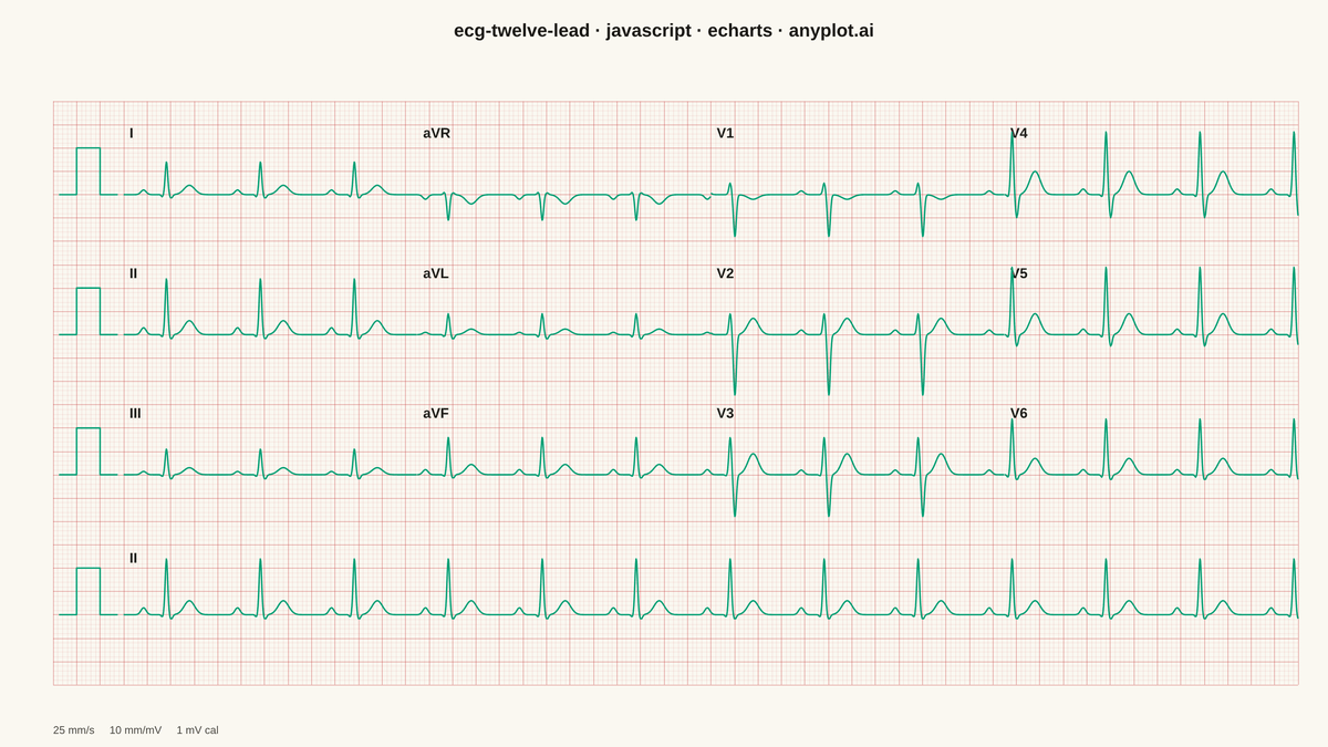 ECG/EKG 12-Lead Waveform Display rendered with Apache ECharts