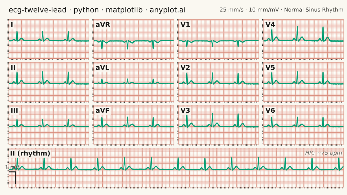 ECG/EKG 12-Lead Waveform Display rendered with Matplotlib