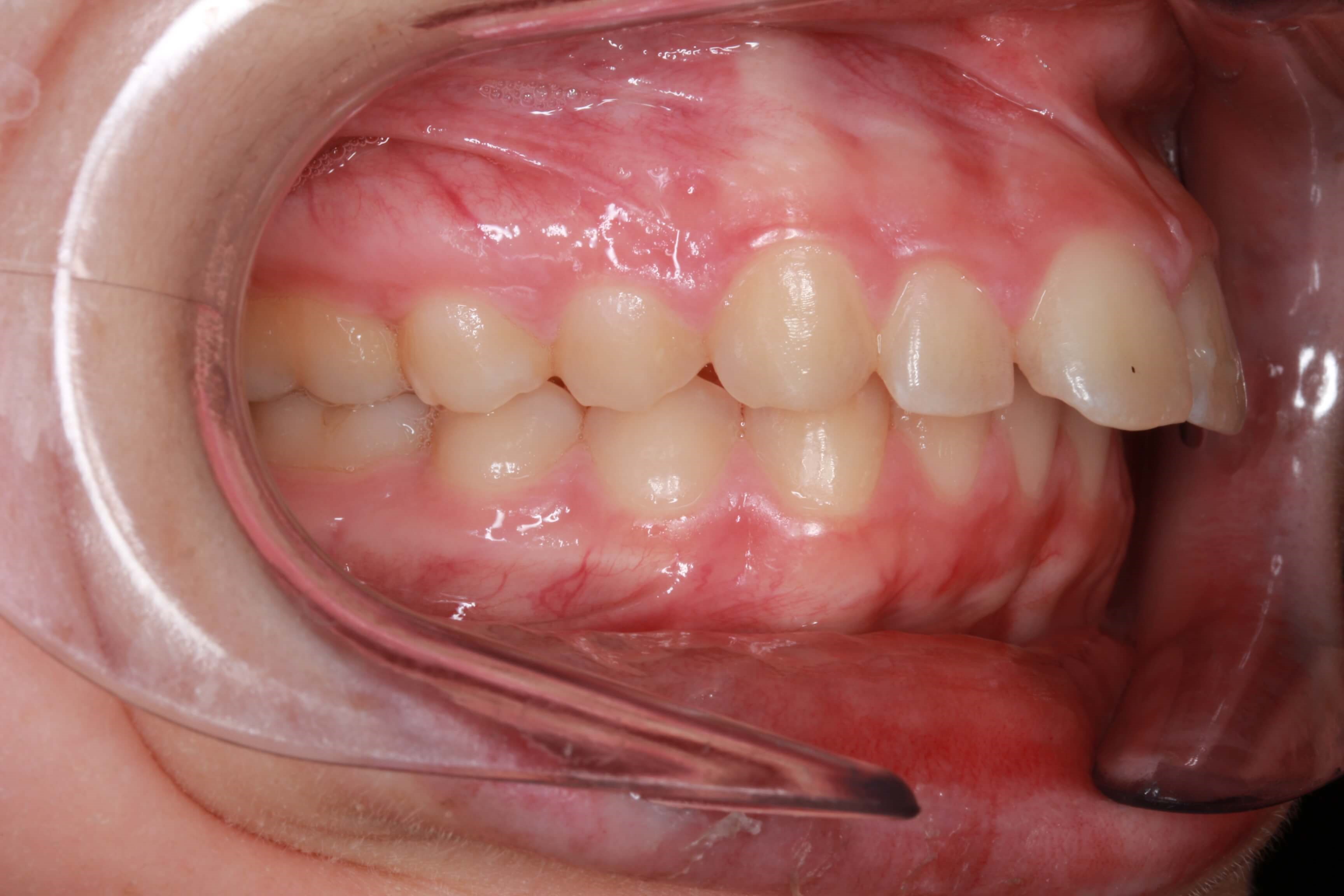 Right Side Bite Before