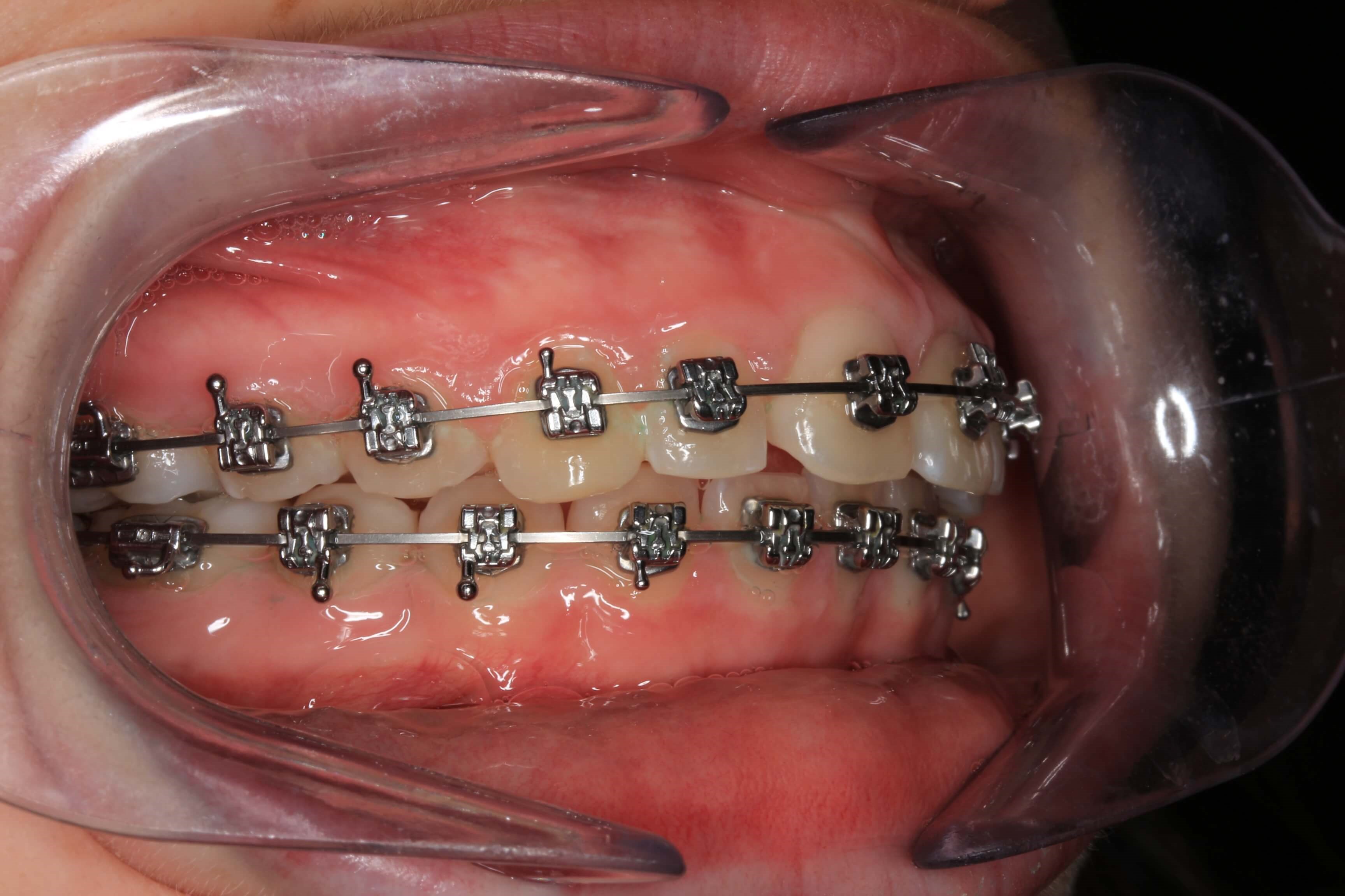 Right Side Bite 1 Year Progress