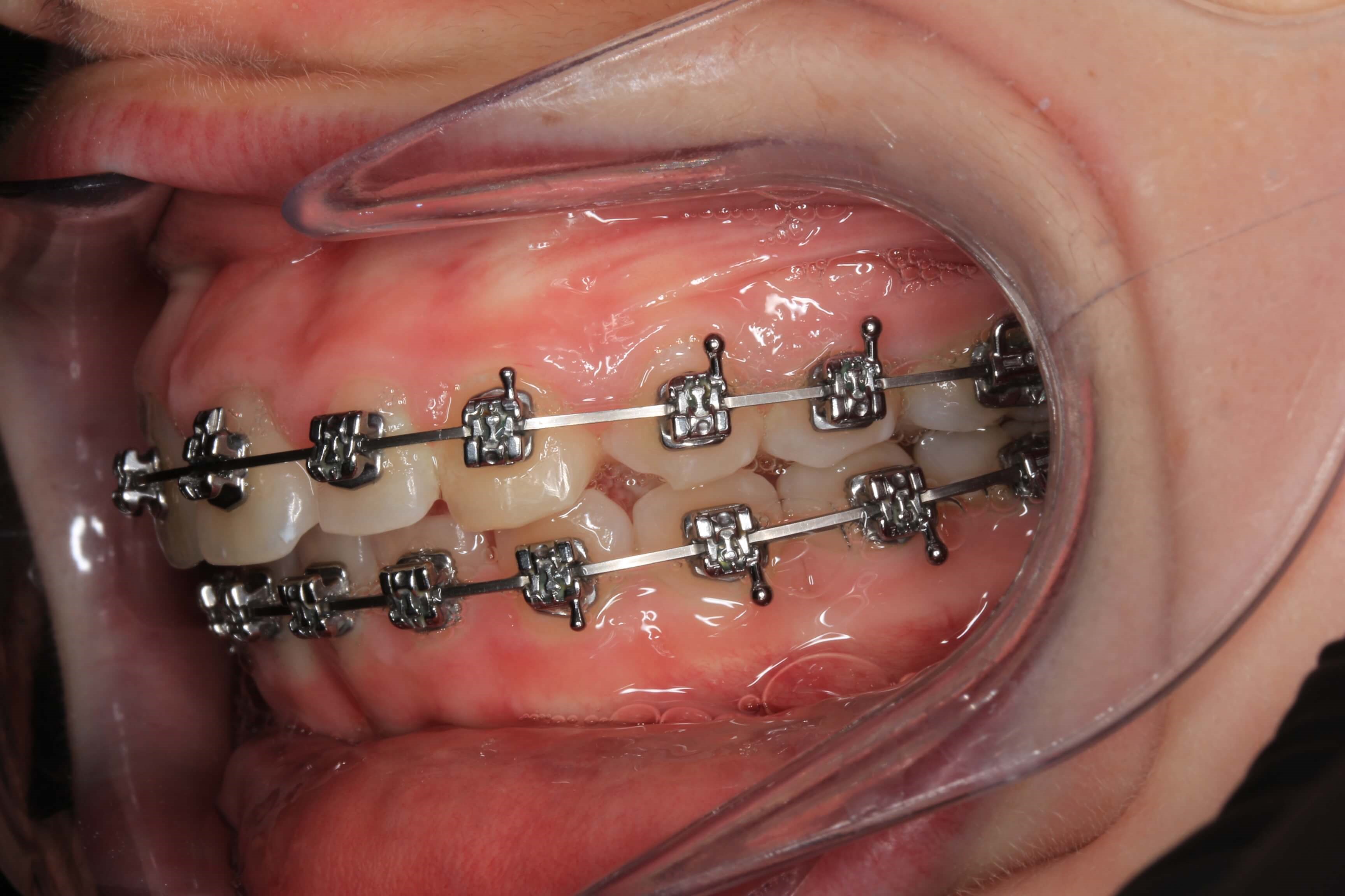 Left Side Bite 1 Year Progress