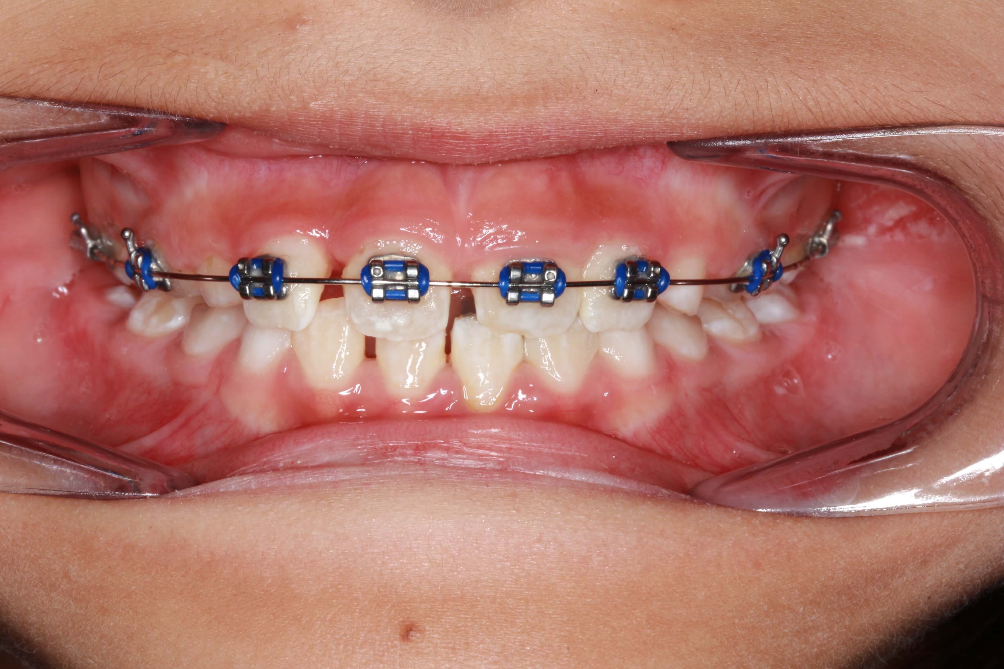 Crossbite Progress 1 Month progress