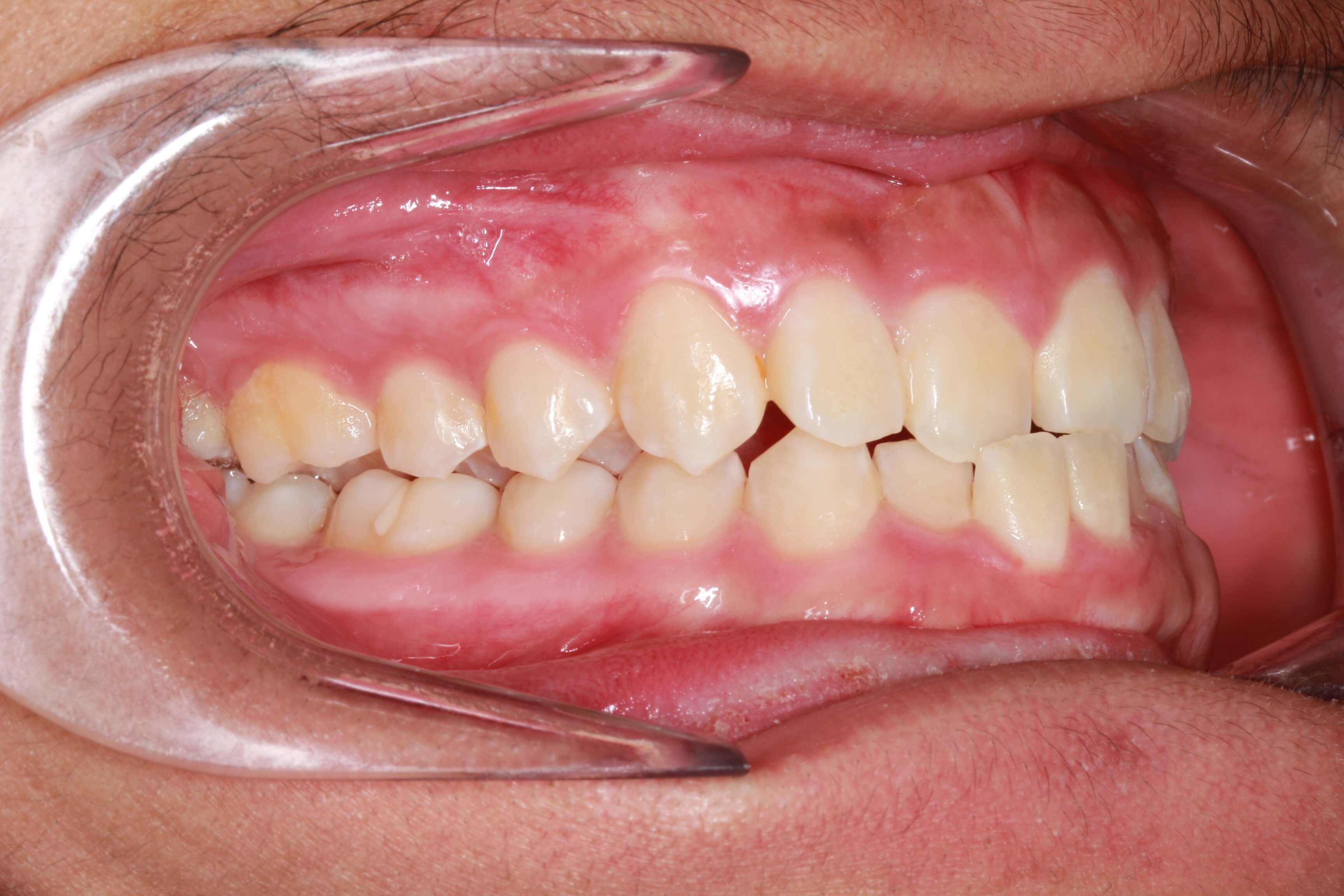 Buccal Right Before