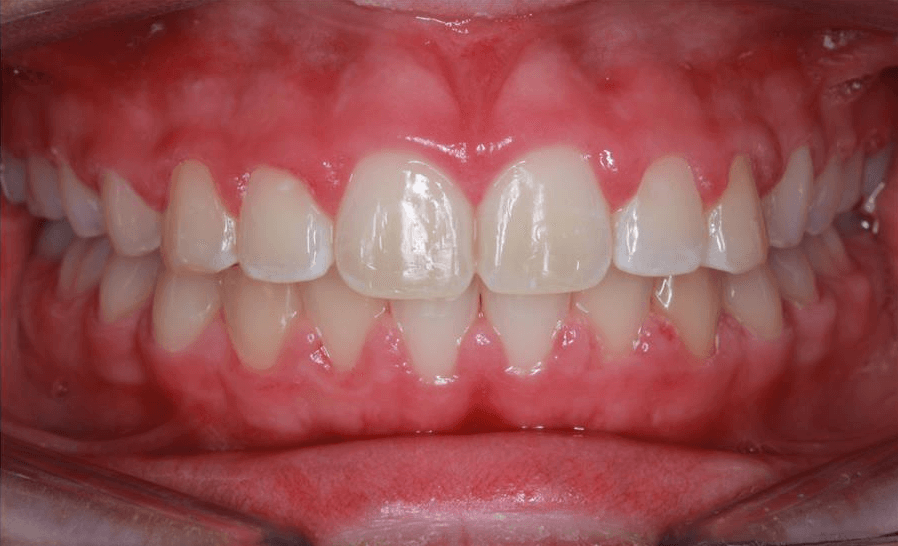 Before and After Center Bite After