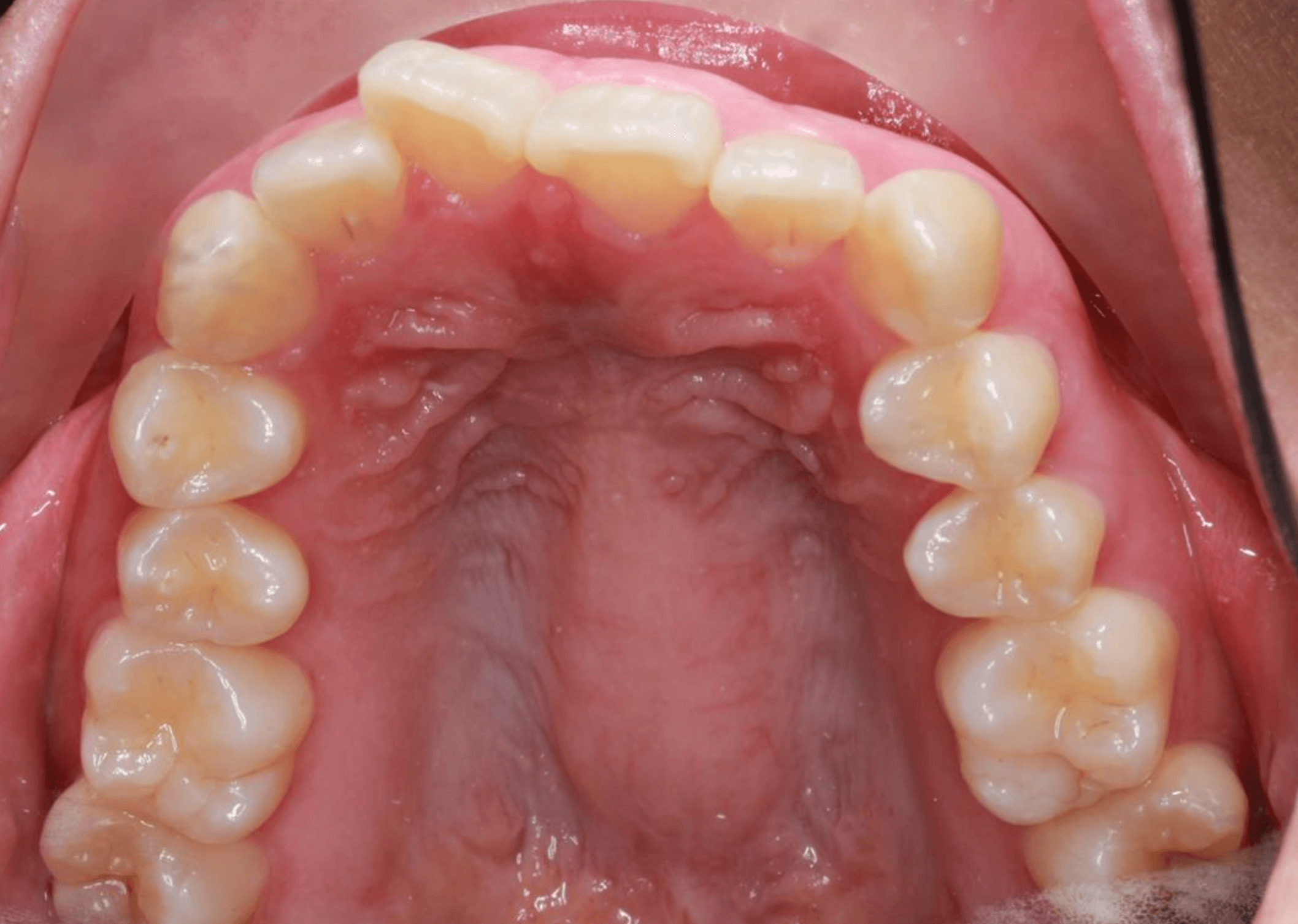 Upper Arch-Progress Before