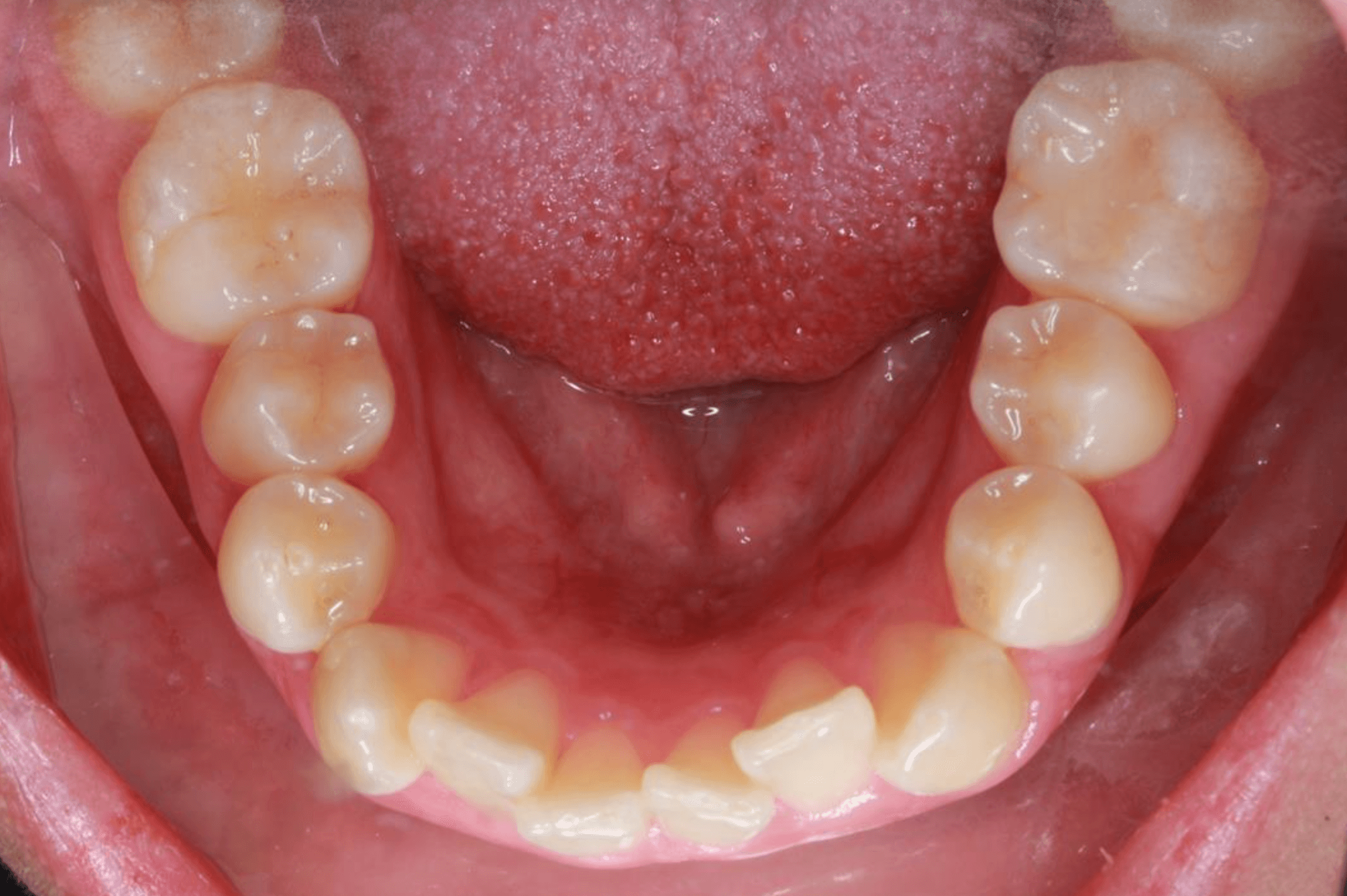 Lower Arch-Progress Before