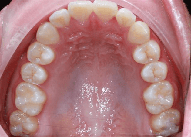 Upper Occlusal After