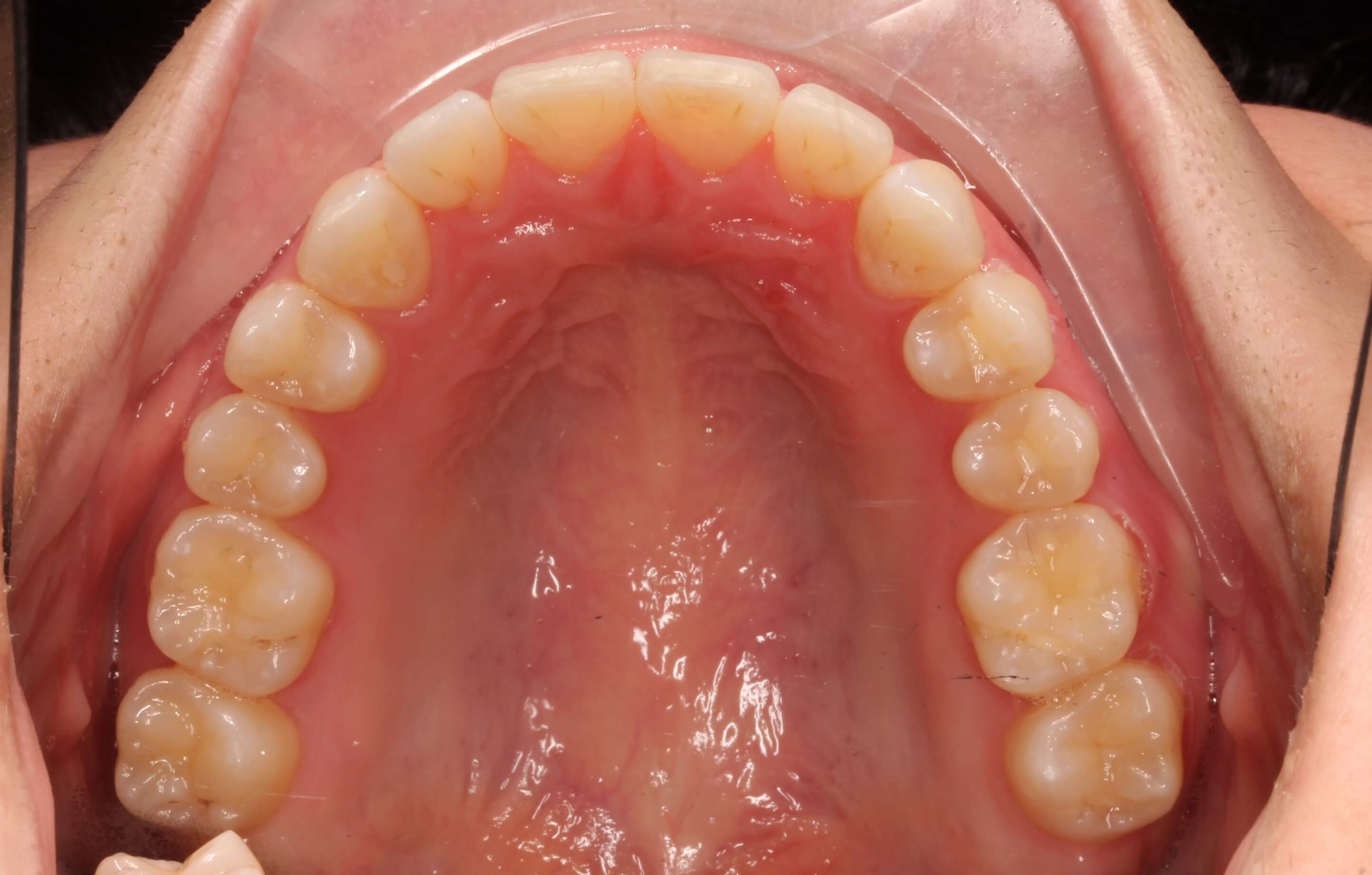 Upper Occlusal After