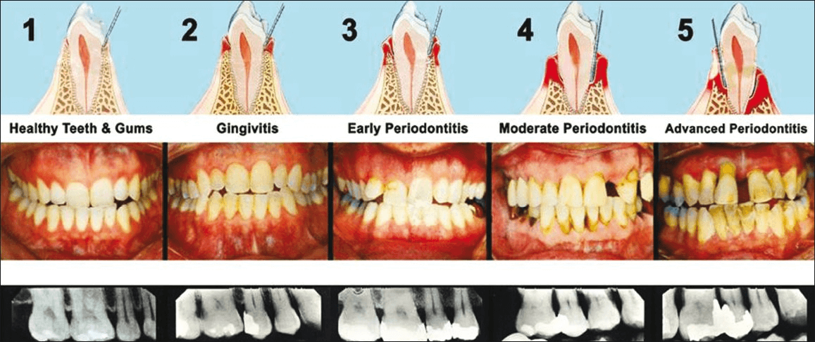 Stages of periodontal disease from healthy gums through advanced periodontitis with x-rays