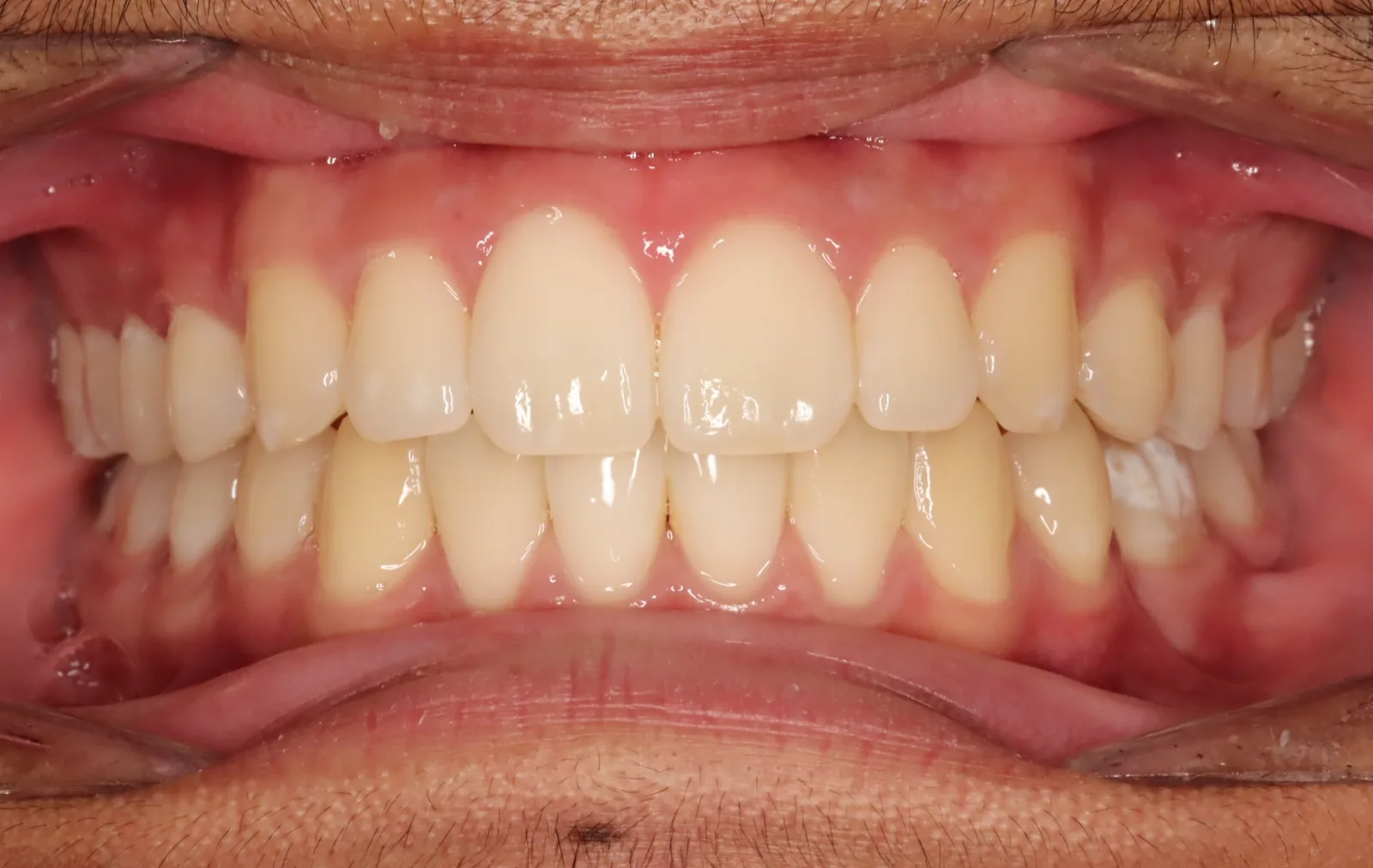 After teeth alignment comparison: Intraoral after photo of Herbst Growth-Guidance Appliance showing the artistry was in timing and balance.