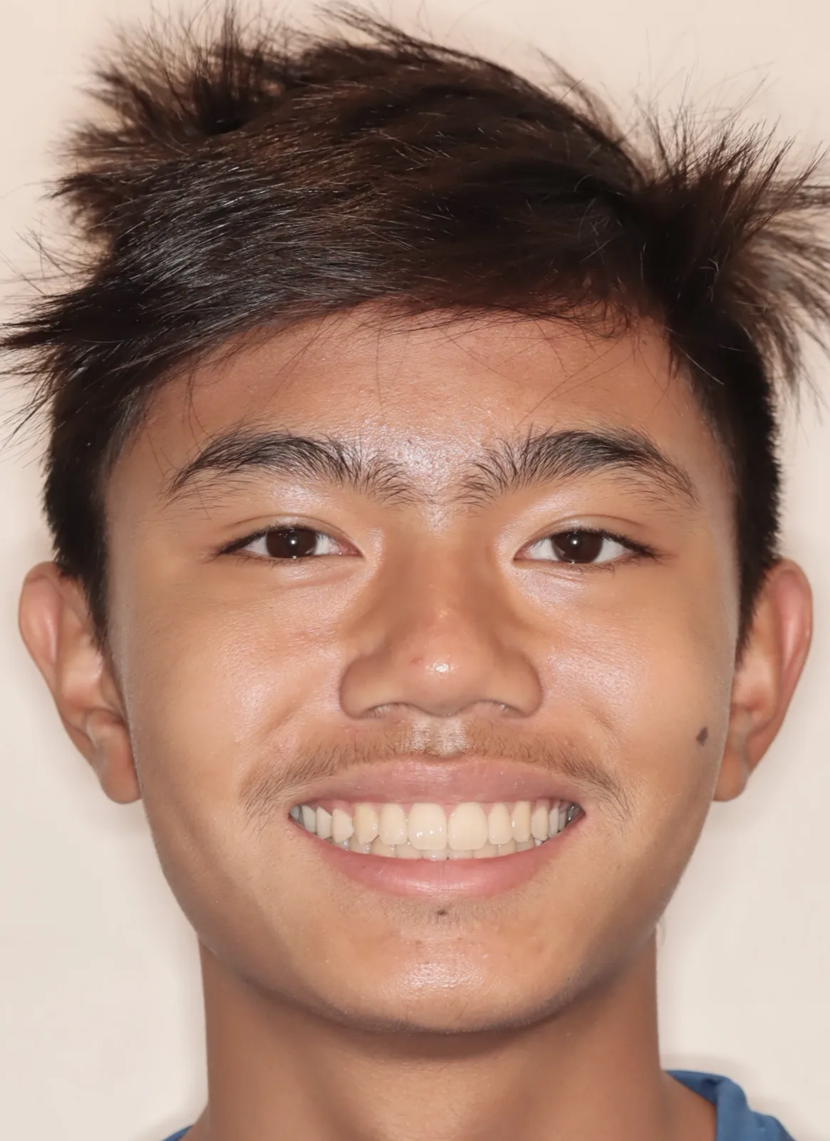 After Herbst Growth-Guidance Appliance treatment