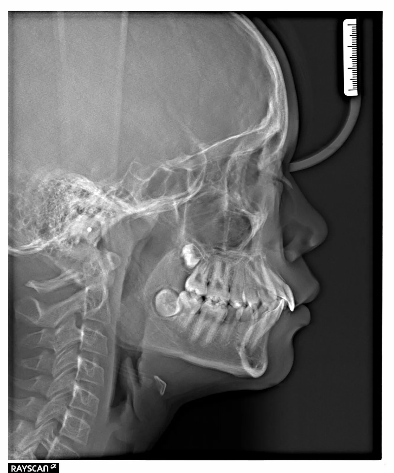 Before orthodontic x-ray: Cephalometric profile before Herbst Growth-Guidance Appliance showing skeletal relationship.