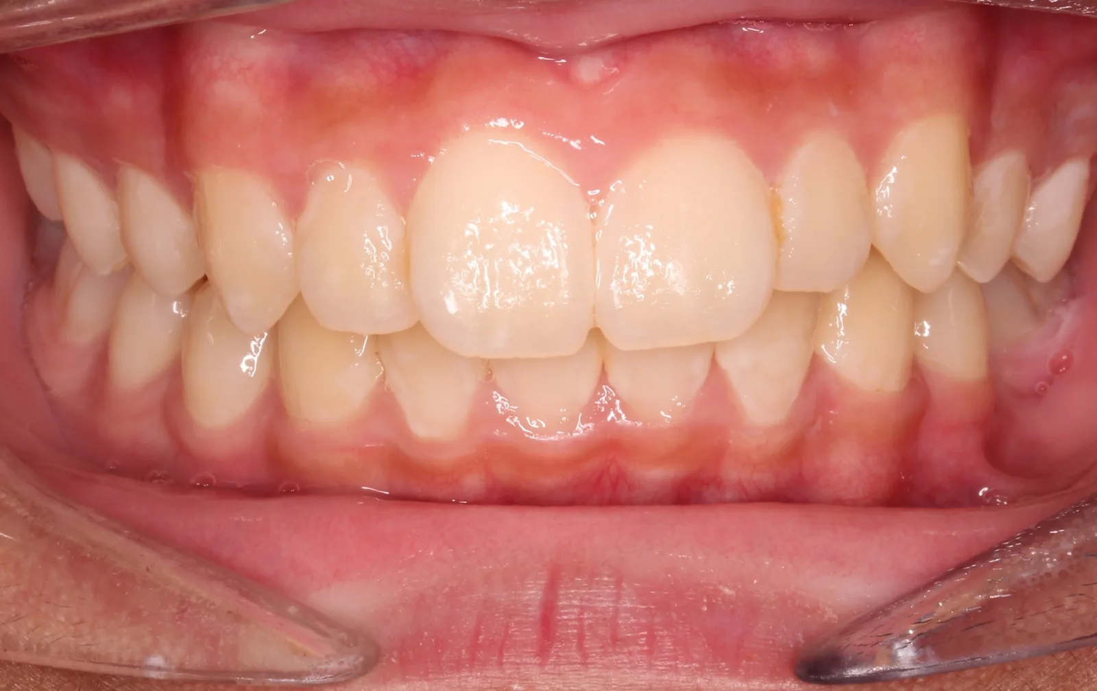 Before teeth alignment comparison: Intraoral before photo of Herbst Growth-Guidance Appliance showing this patient presented with a class ii relationship, excess overjet, and a congenitally missing lower-left second premolar.