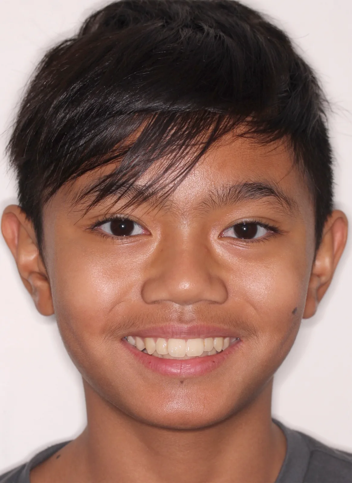 Before Herbst Growth-Guidance Appliance treatment