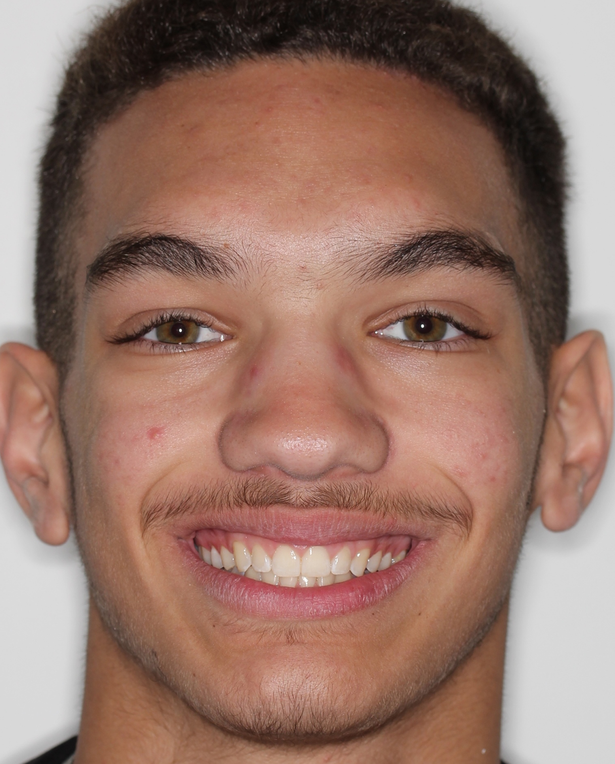 After Removable Clear Aligners treatment