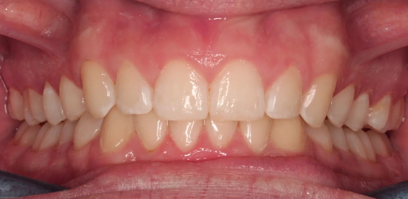 After teeth alignment comparison: Intraoral after photo of Removable Clear Aligners showing this case highlights how digital precision made all the difference.