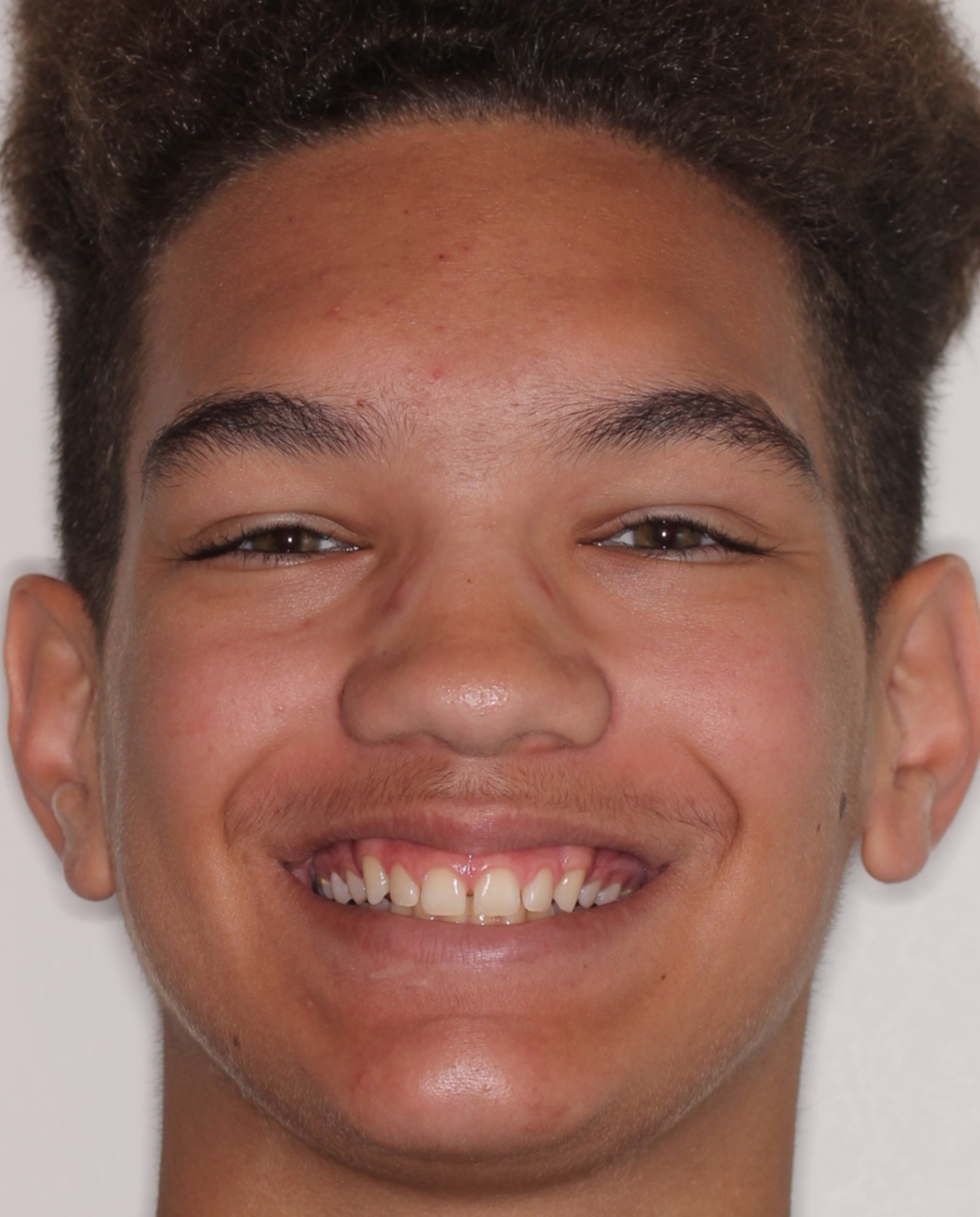 Before Removable Clear Aligners treatment