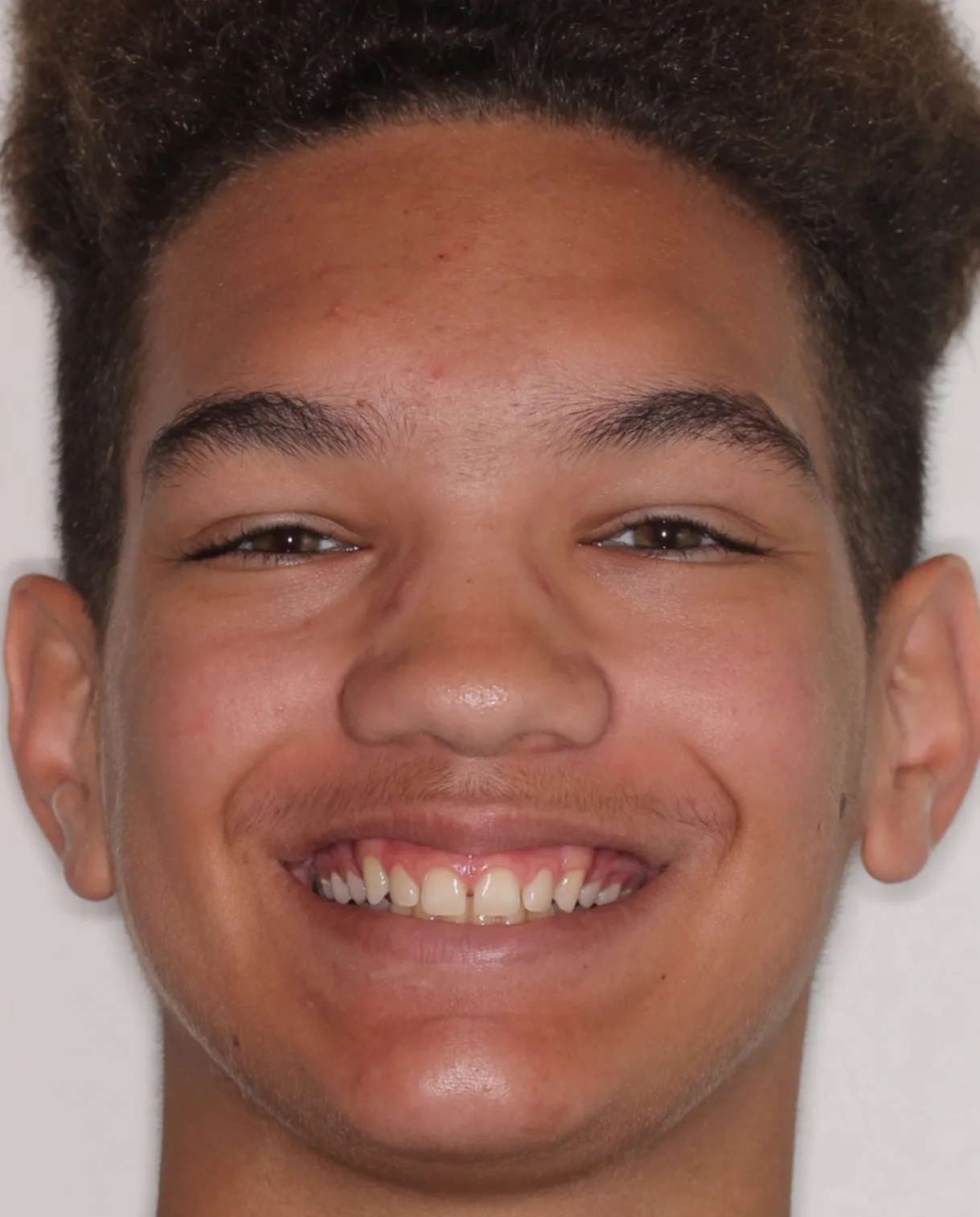 Before Removable Clear Aligners treatment