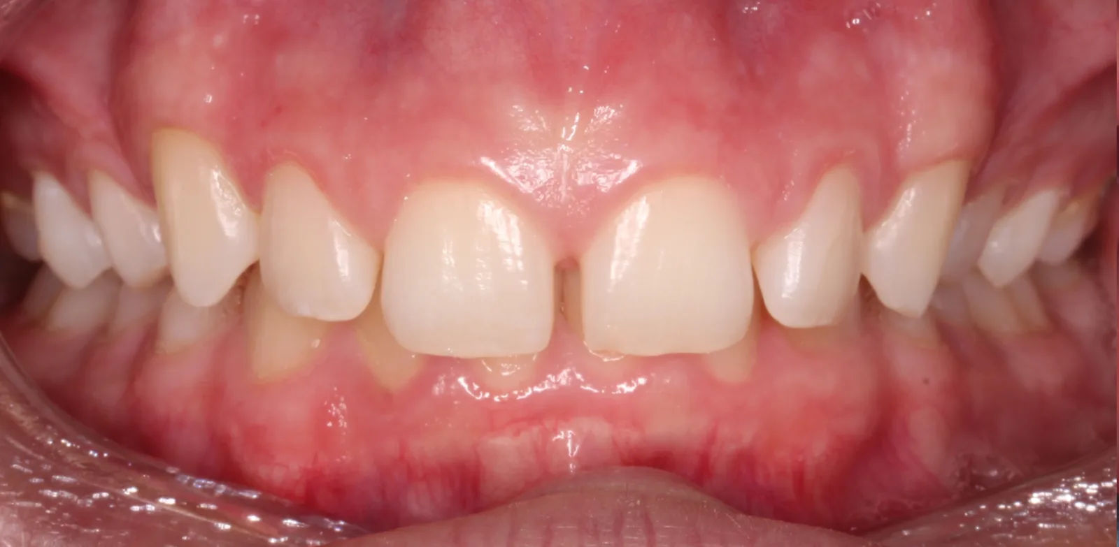 Before teeth alignment comparison: Intraoral before photo of Removable Clear Aligners showing showing digital precision made all the difference.
