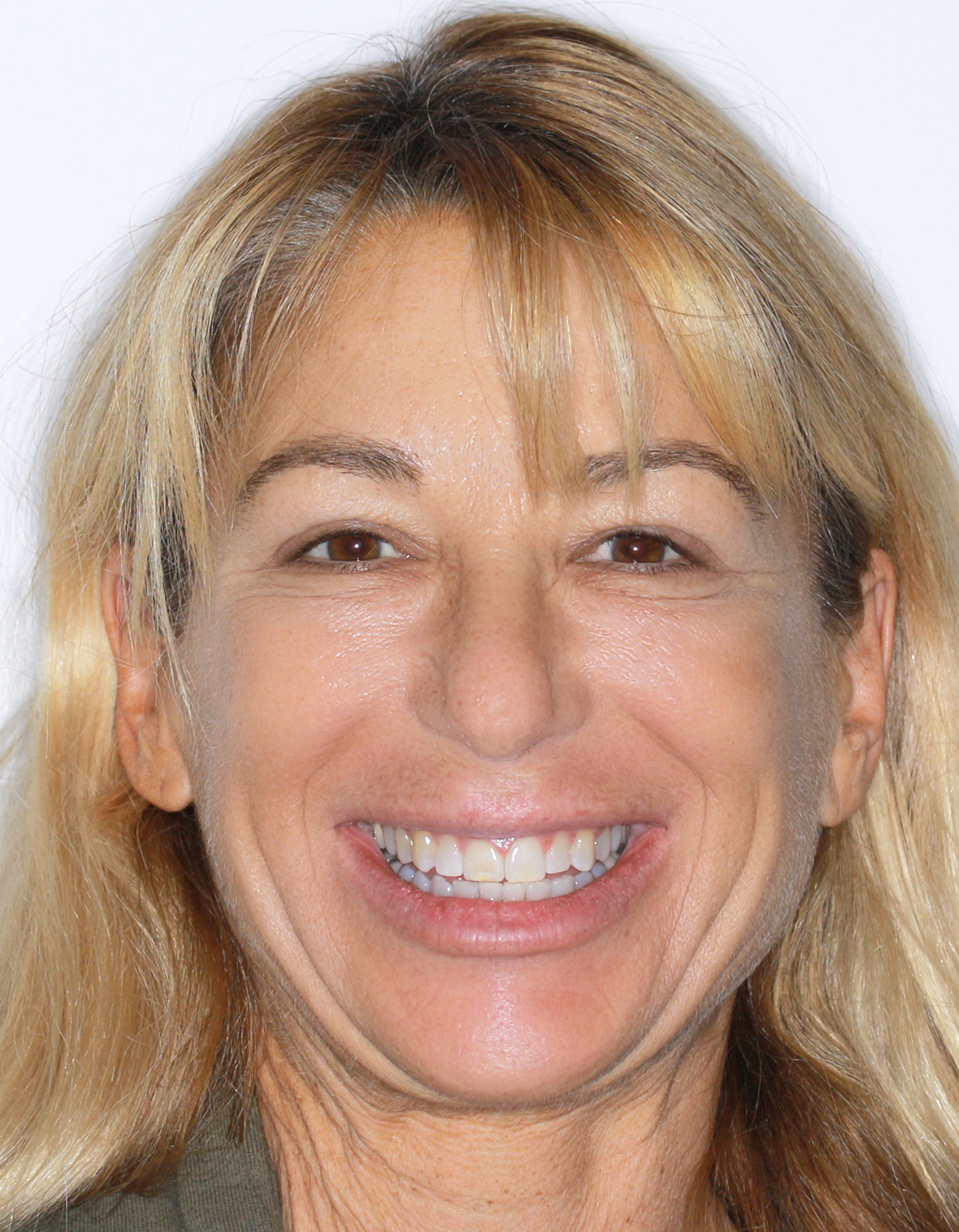 After Removable Clear Aligners treatment