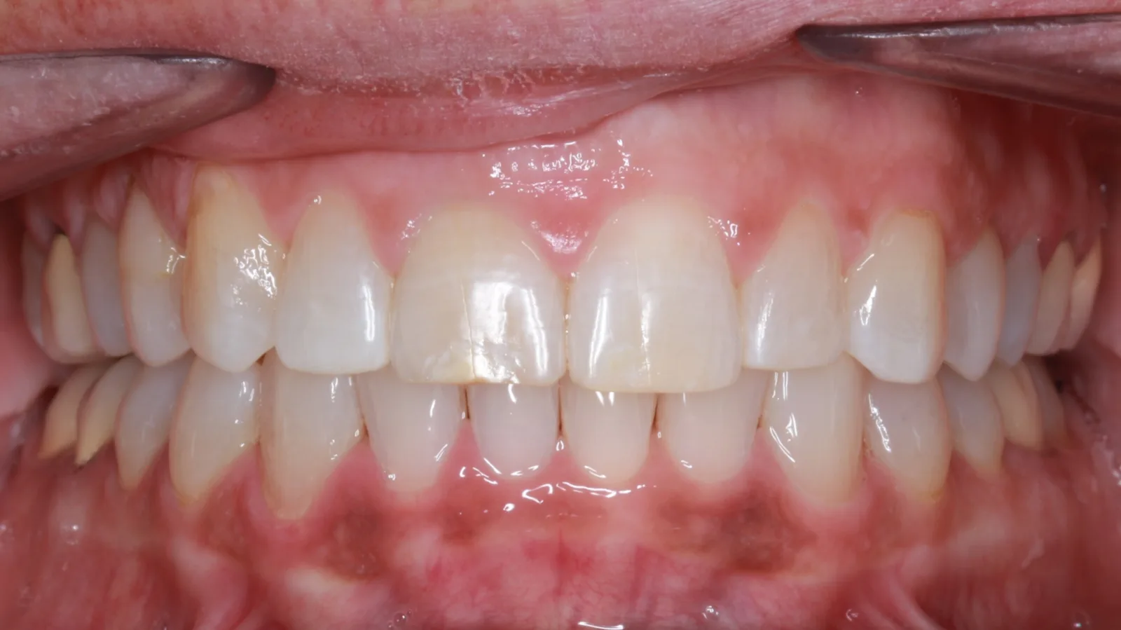 After teeth alignment comparison: Intraoral after photo of Removable Clear Aligners showing the artistry was less about "perfect teeth" and more about designing a smile that fit her life and identity.