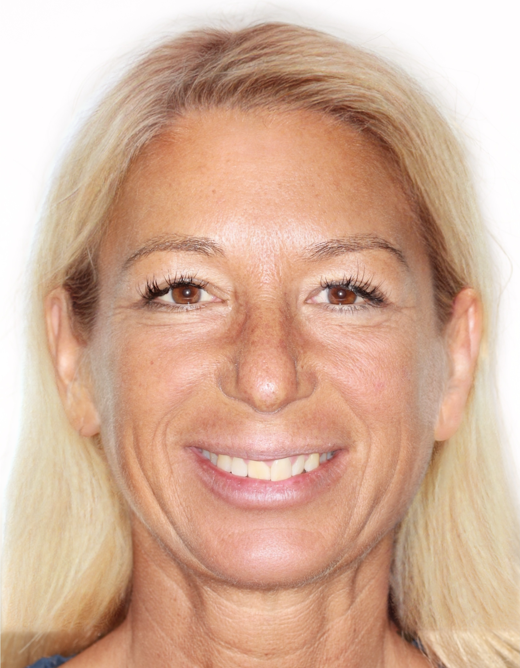 Before Removable Clear Aligners treatment